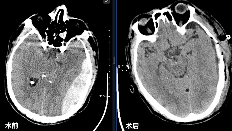 20260203 脑外伤脑出血13.jpg