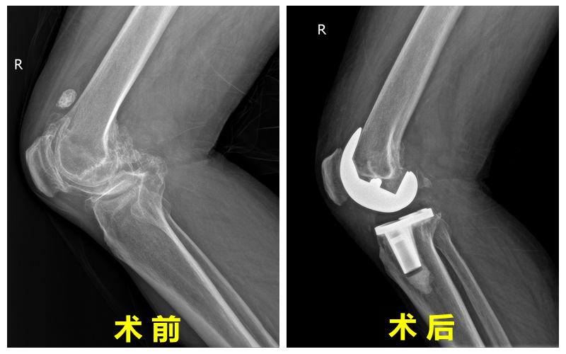 手术对比照.png 手术对比照.png