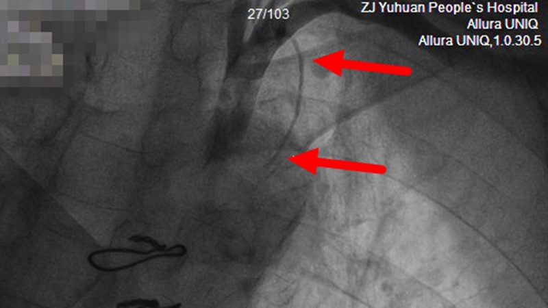 C:\Users\admin\Desktop\20230410心内科搭桥抢救\王熙平 冠脉手术截图 左侧内乳动脉纤细 远端完全闭塞.jpg