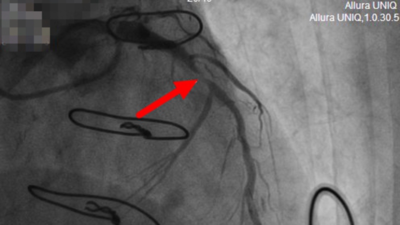 C:\Users\admin\Desktop\20230410心内科搭桥抢救\王熙平 冠脉手术截图 术前 前降支近段严重狭窄.jpg