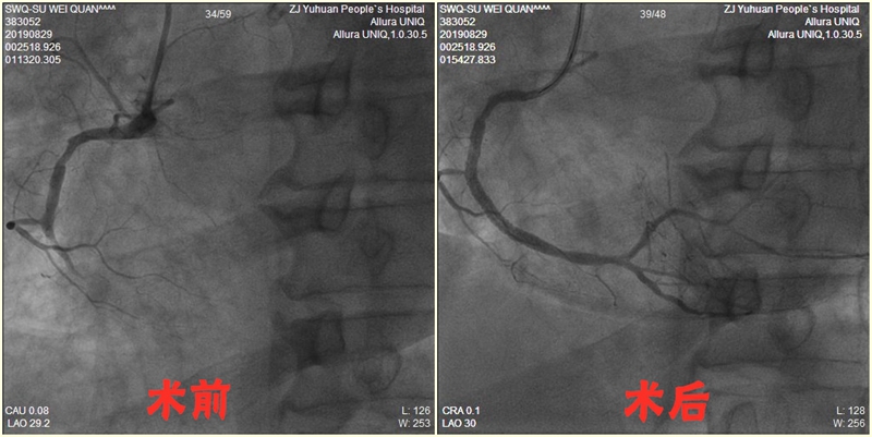 SWQ 右冠 术前_副本.jpg SWQ 右冠 术前_副本.jpg