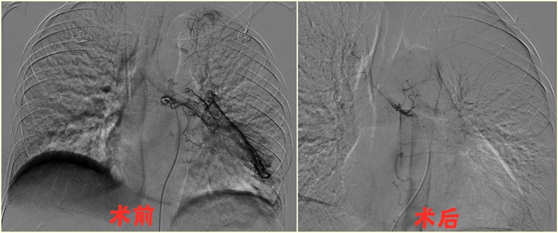 咯血-支气管动脉栓塞术1_副本_副本.jpg 咯血-支气管动脉栓塞术1_副本_副本.jpg