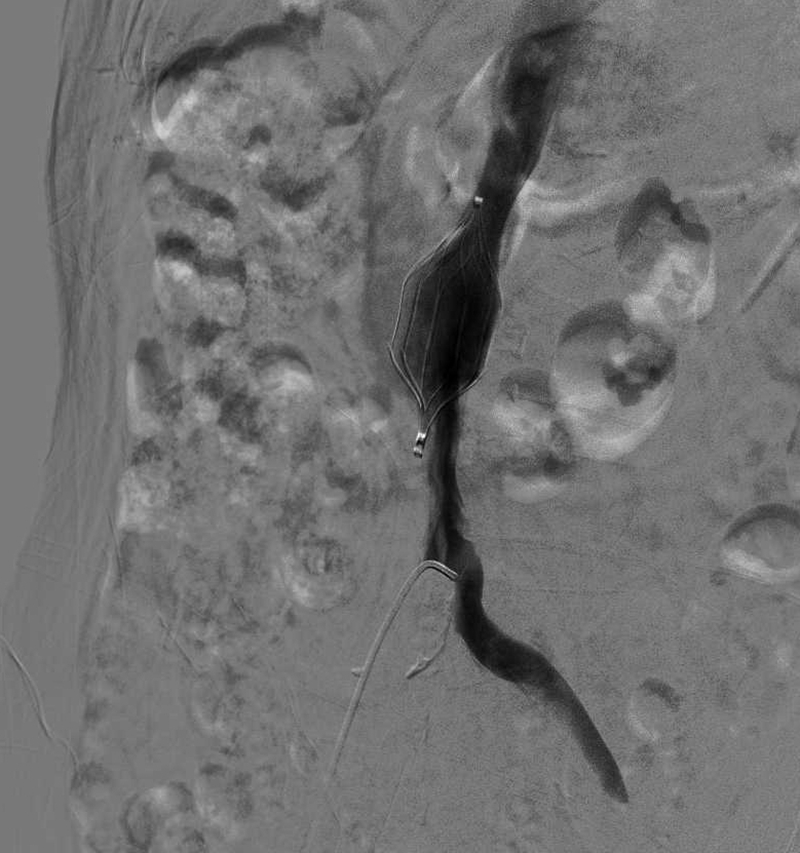 下腔静脉滤器植入及取出.jpg 下腔静脉滤器植入及取出.jpg