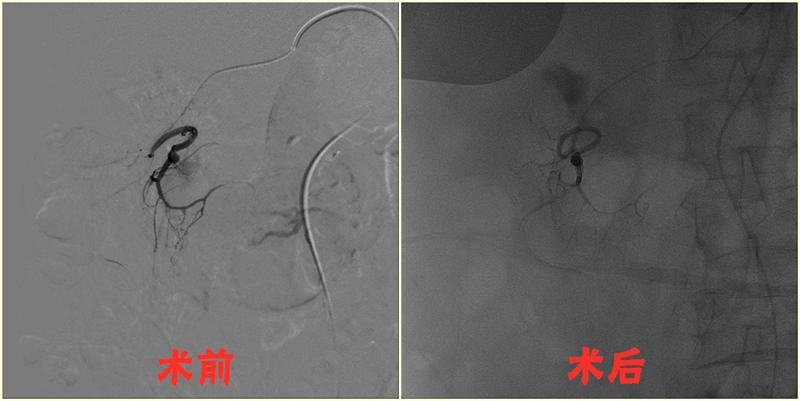 胰十二指肠动脉瘤栓塞术0_副本_副本.jpg 胰十二指肠动脉瘤栓塞术0_副本_副本.jpg