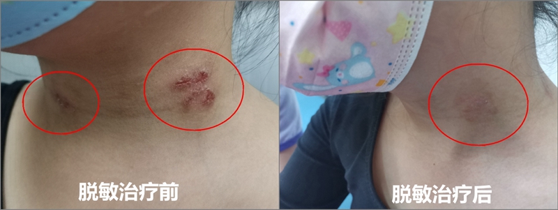 C:\Users\admin\Desktop\20230426脱敏疗法推广\20230426脱敏疗法\NeoImage_副本_副本.jpg C:\Users\admin\Desktop\20230426脱敏疗法推广\20230426脱敏疗法\NeoImage_副本_副本.jpg