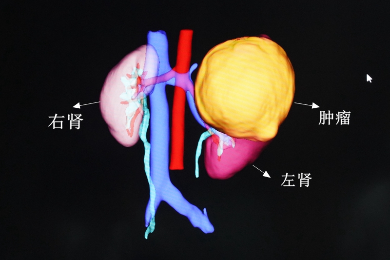 C:\Users\admin\Desktop\20230522泌尿外科10岁女童左肾长巨大肿瘤，宛如第三个肾脏\DSC06254.JPG