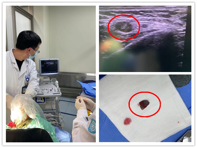 C:\Users\admin\Desktop\20221013急诊取异物\异物2_副本.jpg C:\Users\admin\Desktop\20221013急诊取异物\异物2_副本.jpg