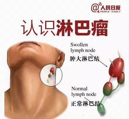 淋巴瘤高清图片.jpeg
