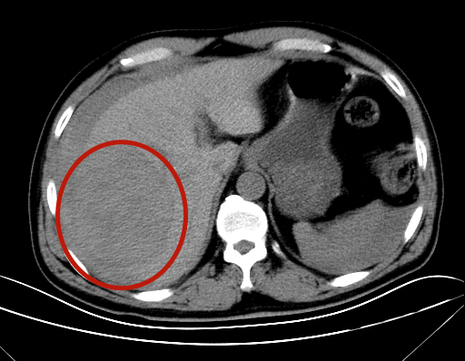 肝脏巨大肿块_副本.jpg